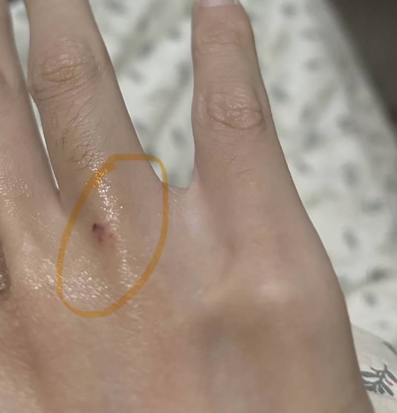 [잡담] 손등관절에 상처난건 밴드 어떻게 붙여야 돼?? | 인스티즈