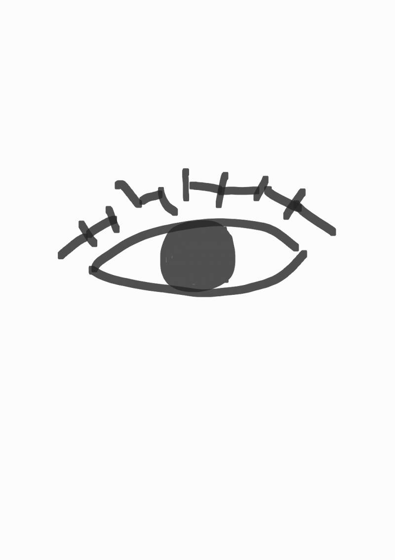 [잡담] 나 이거 쌍수 실밥 풀린거야? | 인스티즈