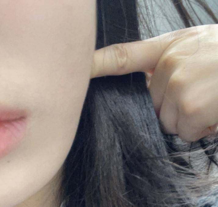 [잡담] 옆턱인지 옆볼인지 두툼해졌는데 온다나 튠페이스 같은 지방 감소 효과 레이저 맞을까? | 인스티즈