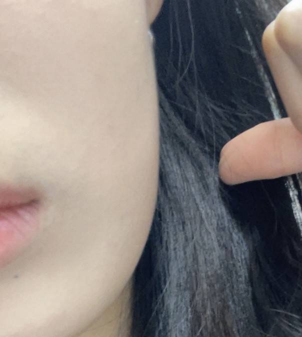 [잡담] 옆턱인지 옆볼인지 두툼해졌는데 온다나 튠페이스 같은 지방 감소 효과 레이저 맞을까? | 인스티즈