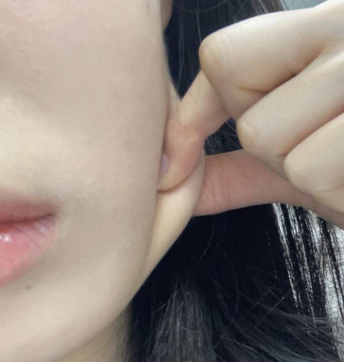 [잡담] 옆턱인지 옆볼인지 두툼해졌는데 온다나 튠페이스 같은 지방 감소 효과 레이저 맞을까? | 인스티즈