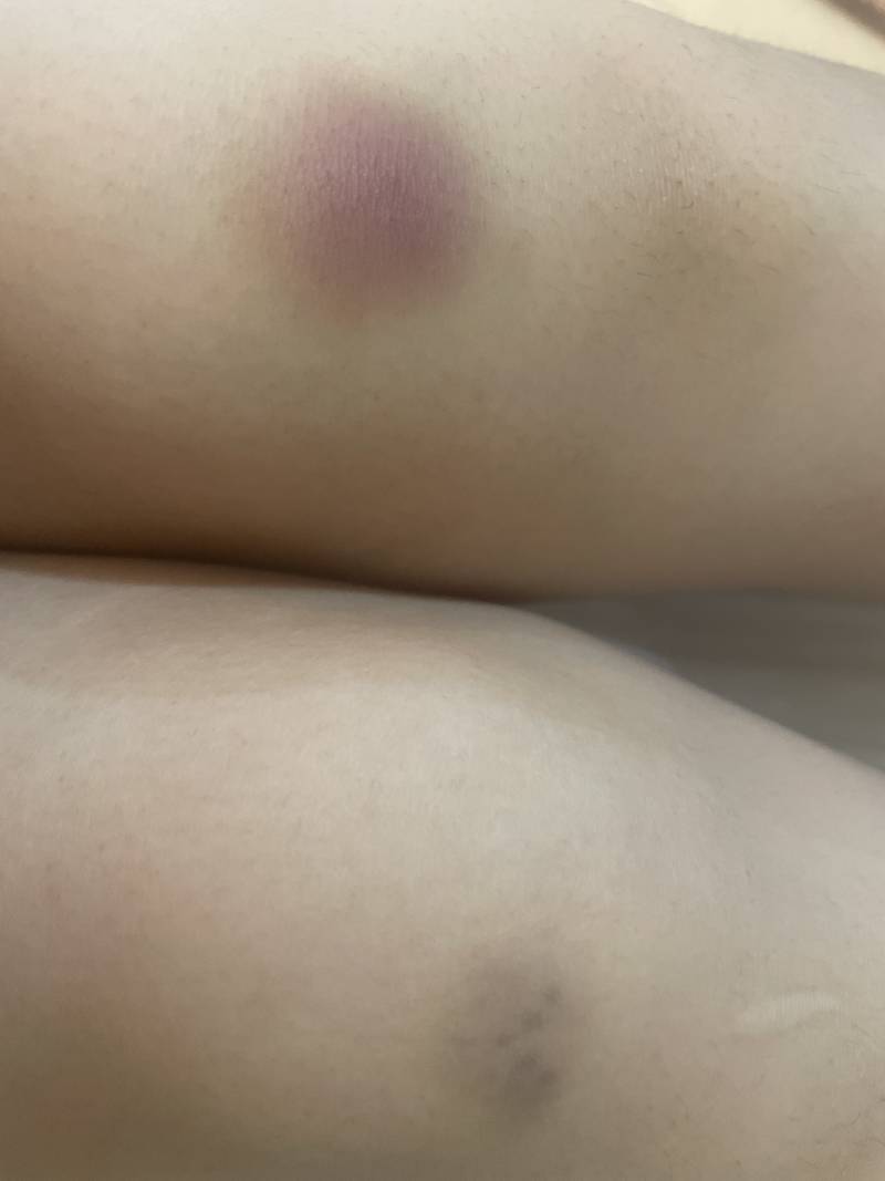 [잡담] 무릎에 ㄹㅈㄷ 멍들었당… | 인스티즈