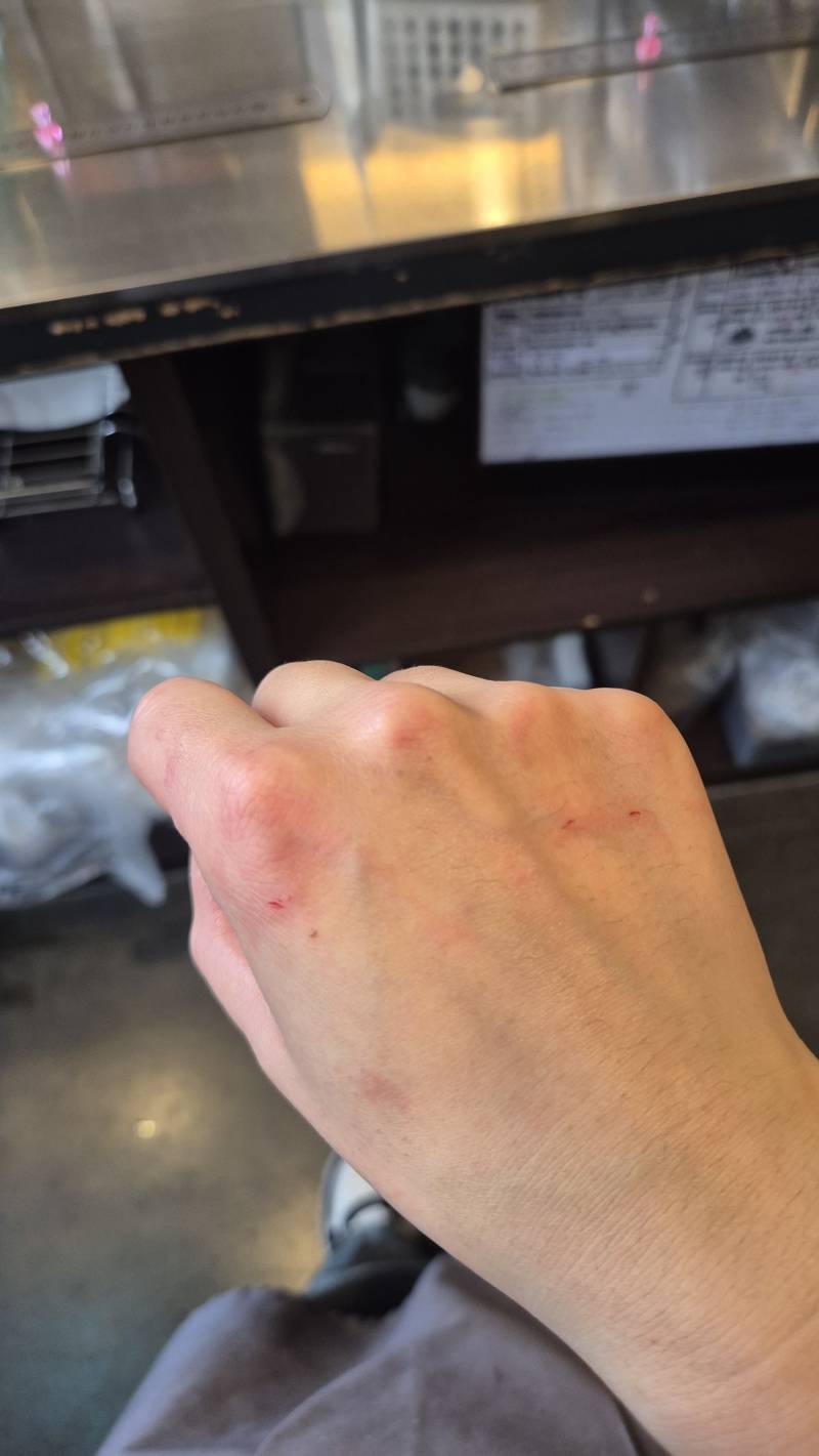 [잡담] 카페 일하다가 제빙기 판 얼음 맞음ㅠ | 인스티즈