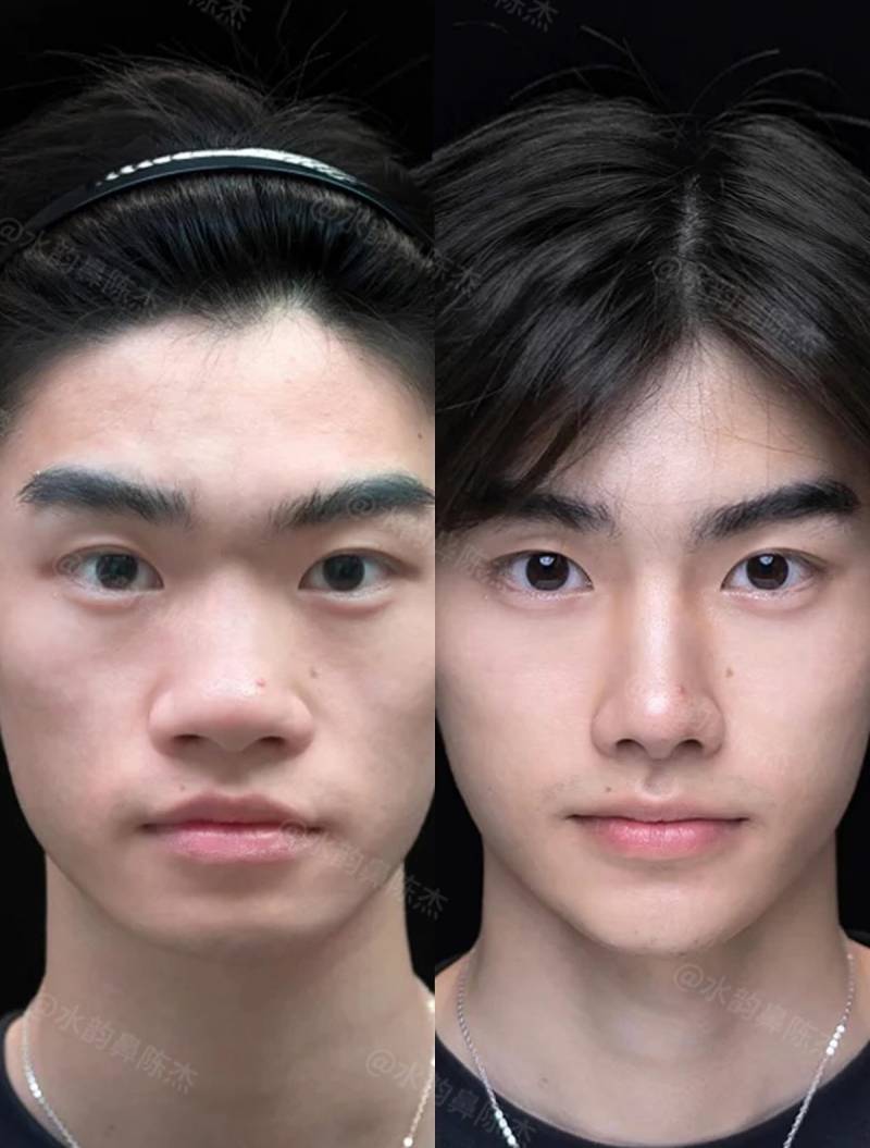 현재 현실적이라는 코 수술 사진..JPG | 인스티즈
