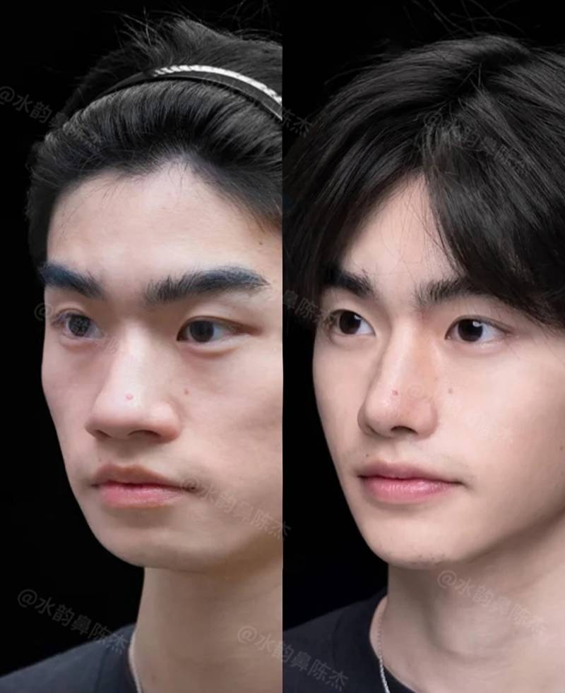 현재 현실적이라는 코 수술 사진..JPG | 인스티즈