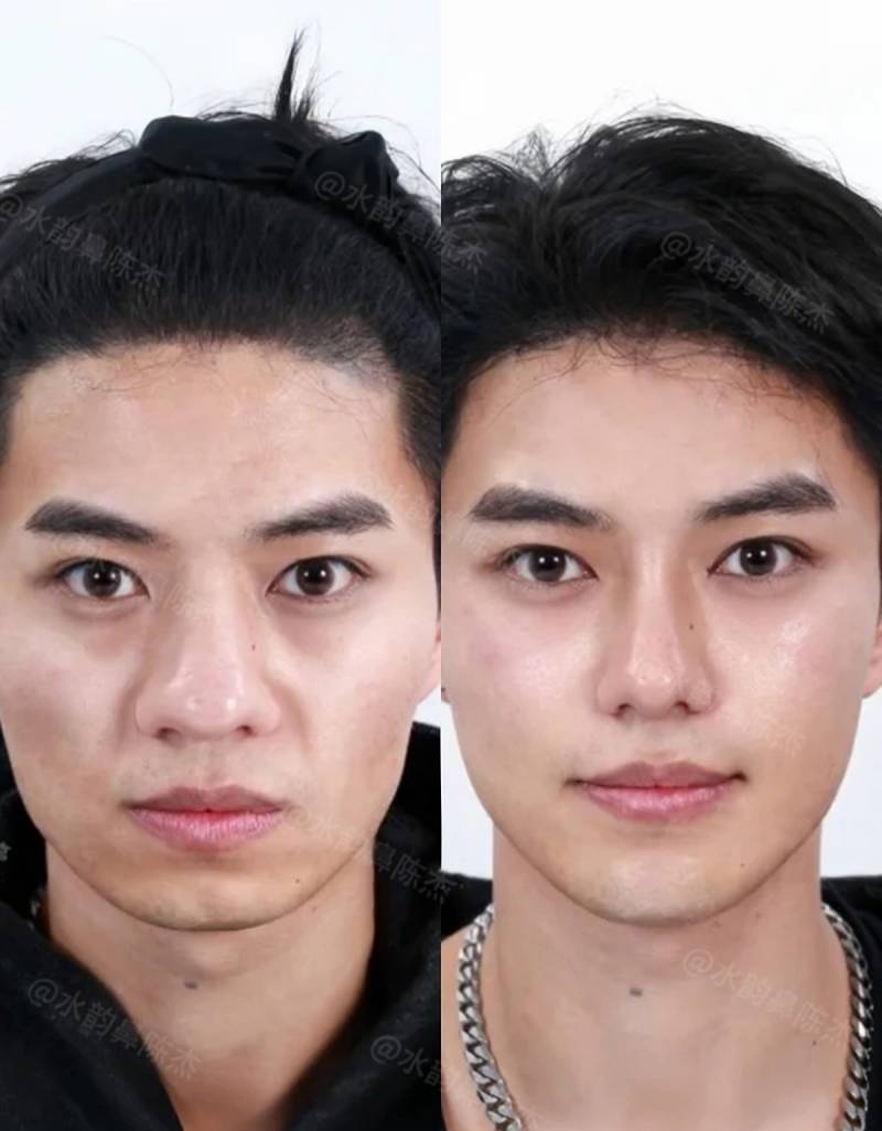 현재 현실적이라는 코 수술 사진..JPG | 인스티즈