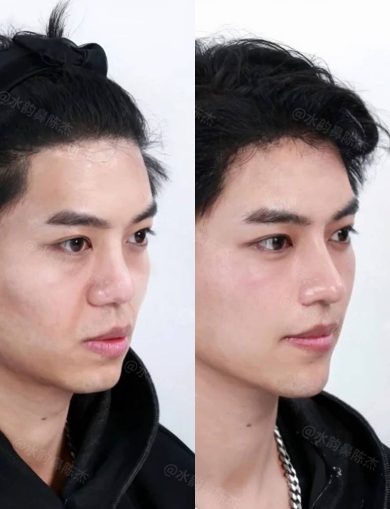현재 현실적이라는 코 수술 사진..JPG | 인스티즈