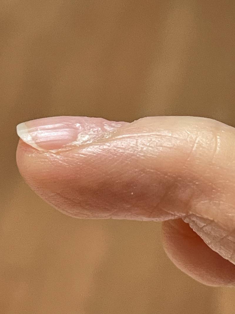 [잡담] 손톱에 변형오는 건 왜그런거야..? | 인스티즈