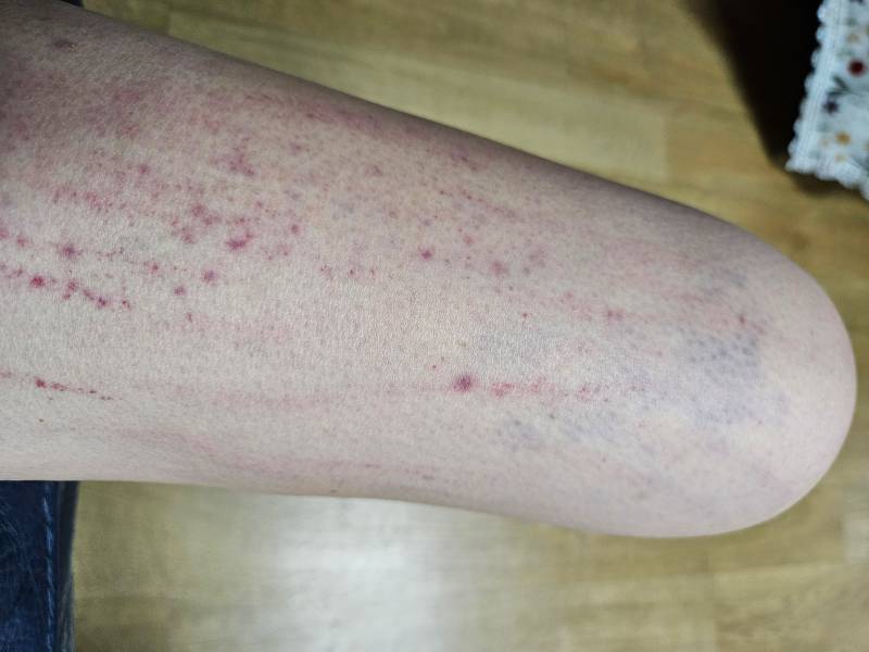 [잡담] 가려워서 긁었는데 이렇게 됐어.... | 인스티즈