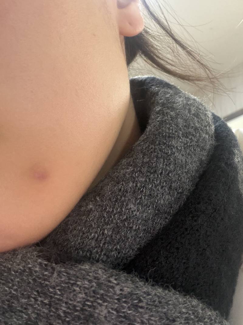 [잡담] 사진O) 이런 여드름은 여드름 주사 맞아도 될까..? | 인스티즈