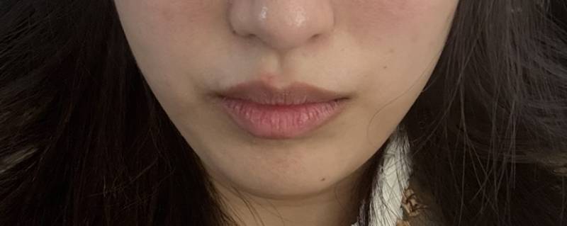 [잡담] 슈링크 맞았는데 신기햐 | 인스티즈