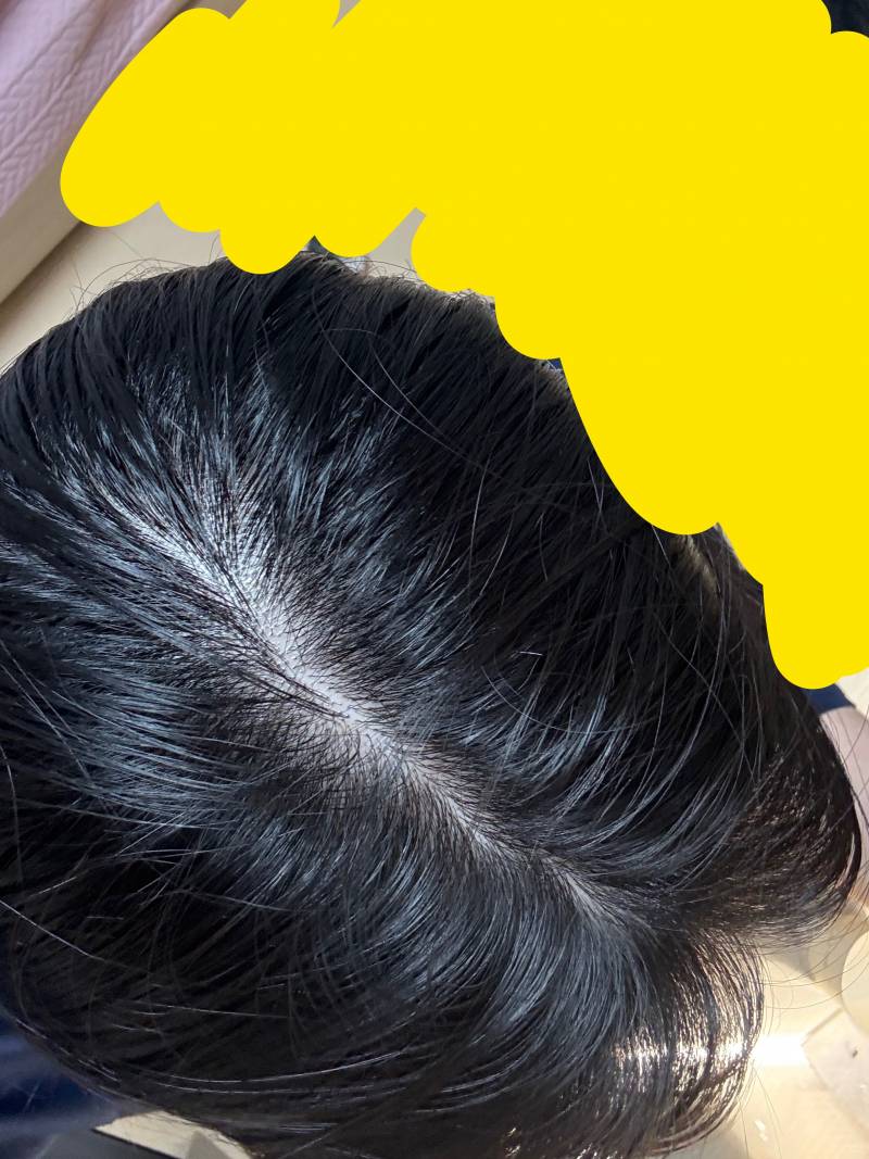 [잡담] 나 탈모야? | 인스티즈