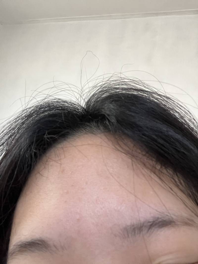 [잡담] 이마가 자꾸 이 gr러 뒤집어지면 어떡해야돼?? | 인스티즈