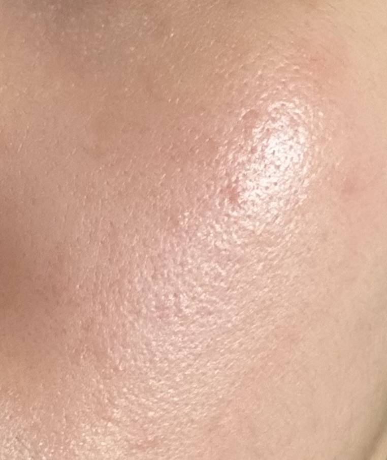 [잡담] 피부 오돌토돌한거 편평사마귀인가? | 인스티즈