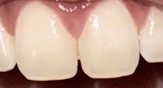 [잡담] 앞니 벌어짐 레진으로 채웠던거 좀 탈락된거같아?? | 인스티즈