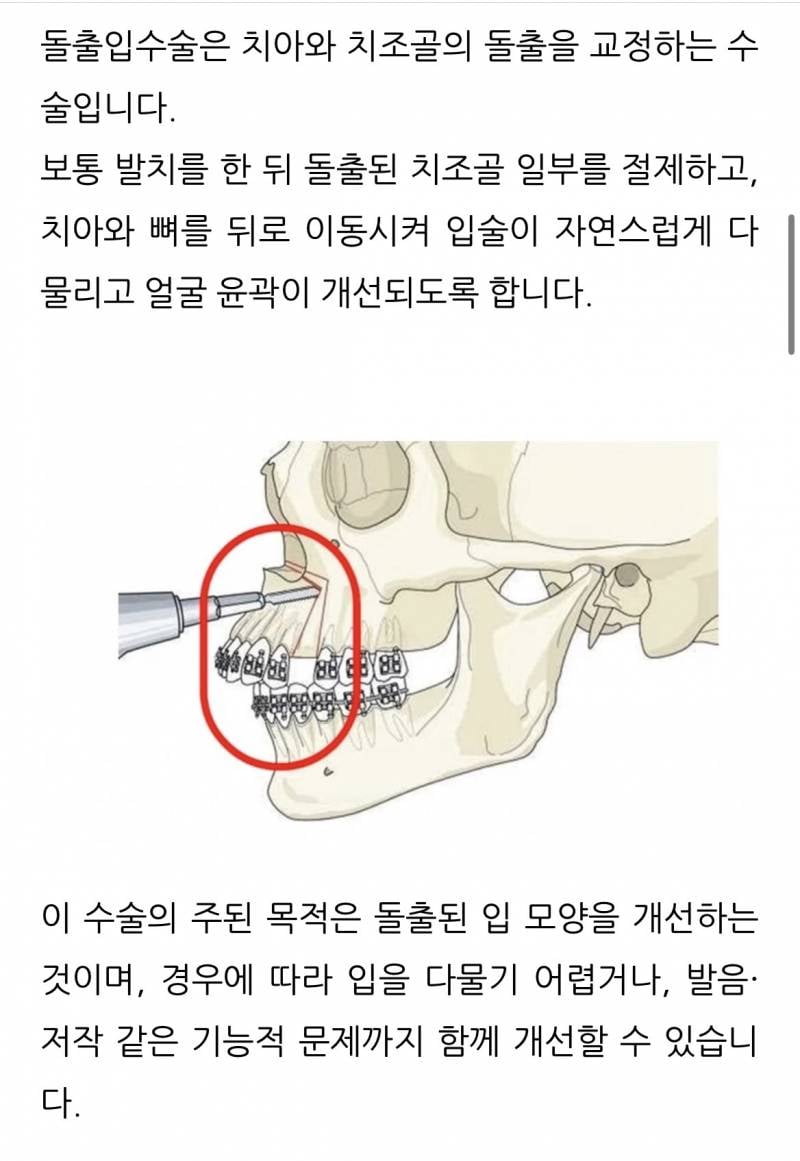 [잡담] 돌출입인 사람 있어? | 인스티즈