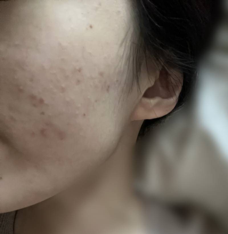 [잡담] 얘두라 나 피부과 가야할거 같아 ?😿 | 인스티즈