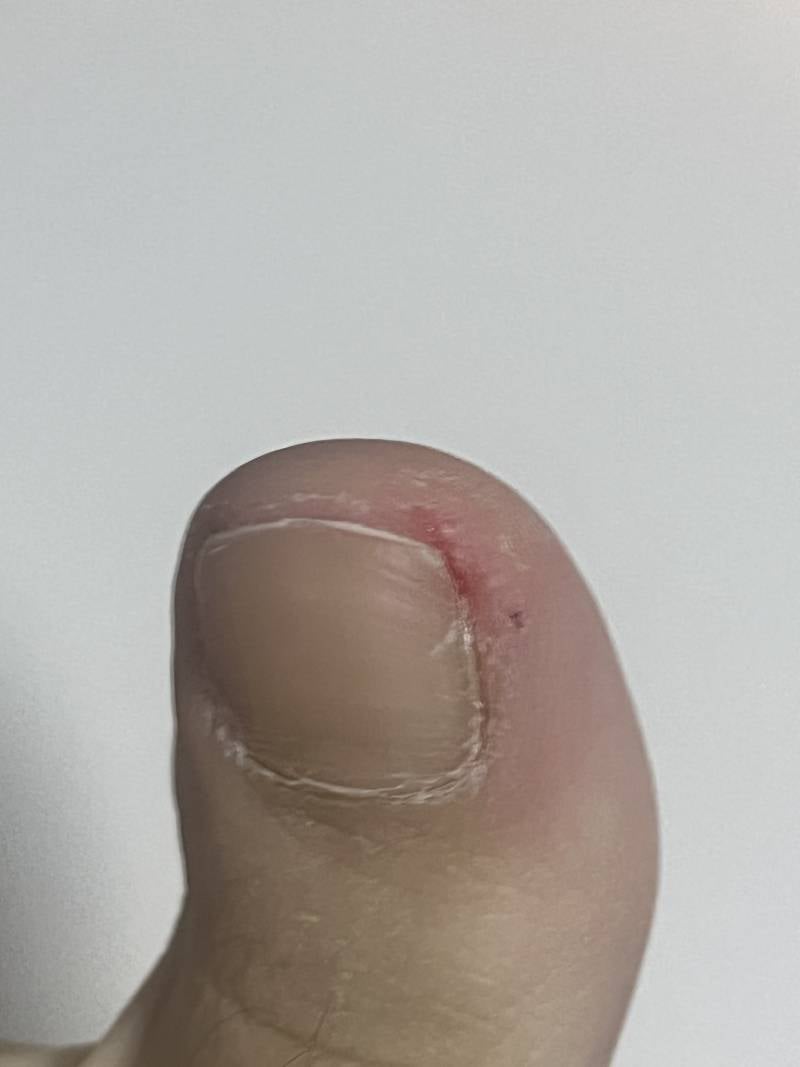 [잡담] 이거 내성발톱인지 봐주라ㅠㅜㅜㅠ 넘 아파 도와줘 ㅠㅠㅠ (혐오주의) | 인스티즈