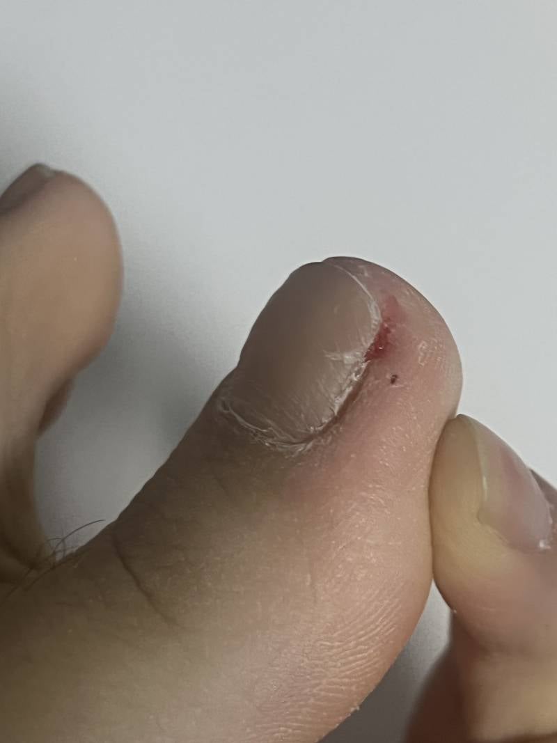 [잡담] 이거 내성발톱인지 봐주라ㅠㅜㅜㅠ 넘 아파 도와줘 ㅠㅠㅠ (혐오주의) | 인스티즈