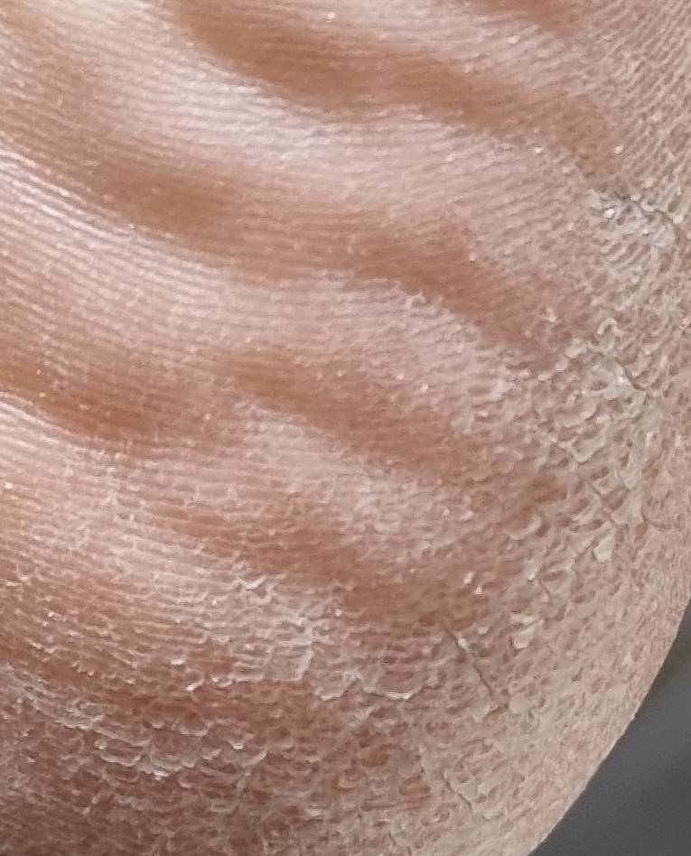 [잡담] 혐오주의 나 발각질 심한데 어째야할까 | 인스티즈