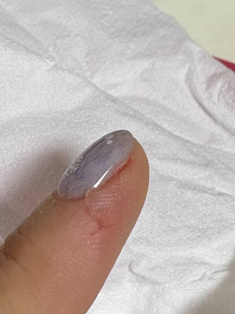 [잡담] ㅎㅇㅈㅇ 나 상처 좀 봐주라 ㅜㅜ | 인스티즈