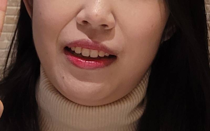 [잡담] 나 팔자주름 너무심한데 이거 어케 없애 | 인스티즈