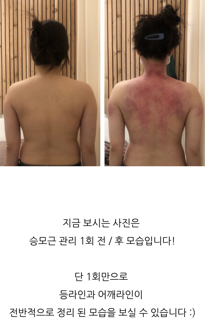 𝙅𝙊𝙉𝙉𝘼 놀랍다는 승모근 교정 후기..JPG | 인스티즈