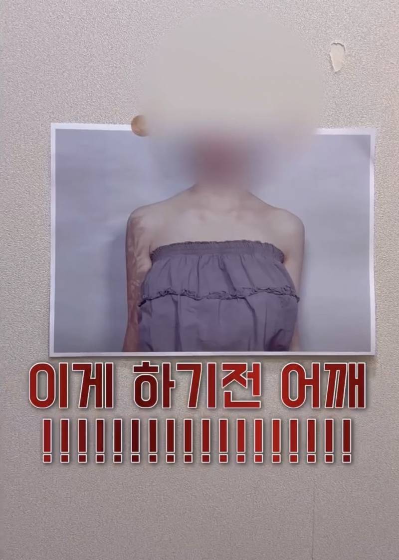 현재 어깨 필러 맞았다는 조두팔..JPG | 인스티즈