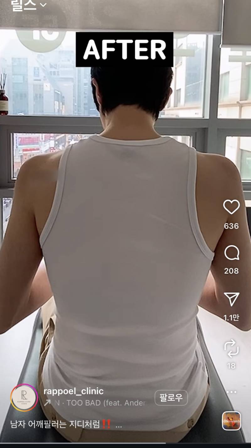 현재 어깨 필러 맞았다는 조두팔..JPG | 인스티즈