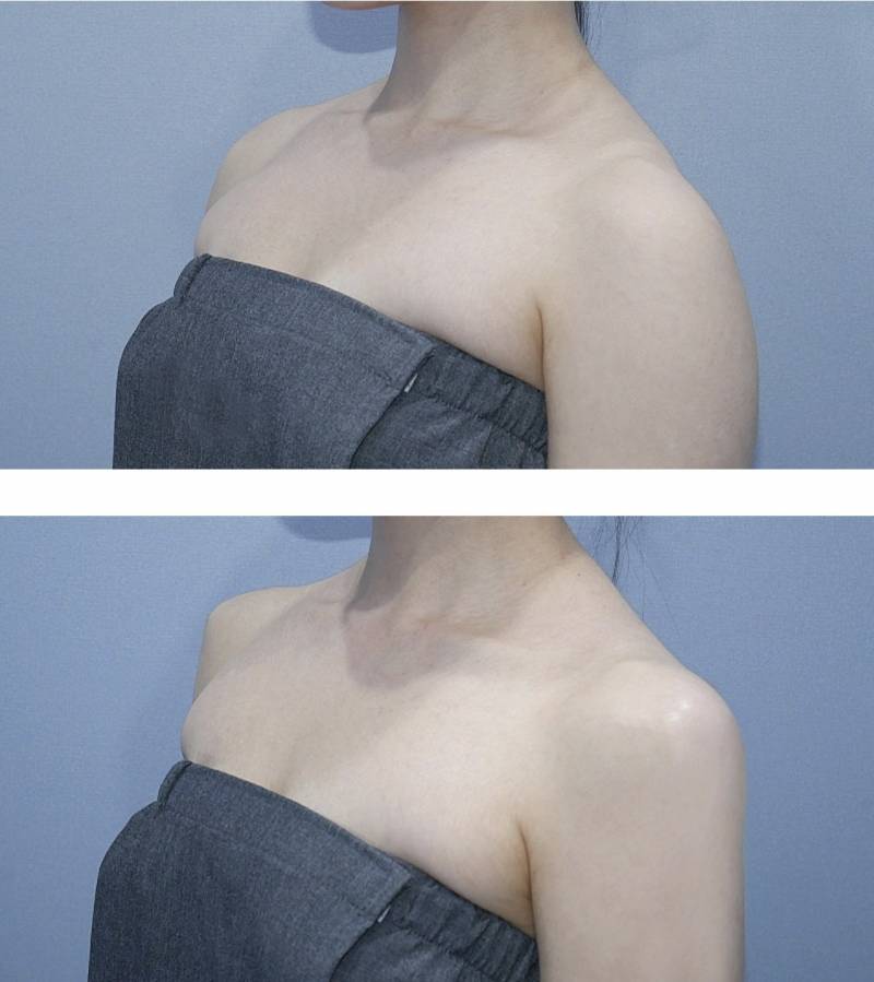 현재 어깨 필러 맞았다는 조두팔..JPG | 인스티즈