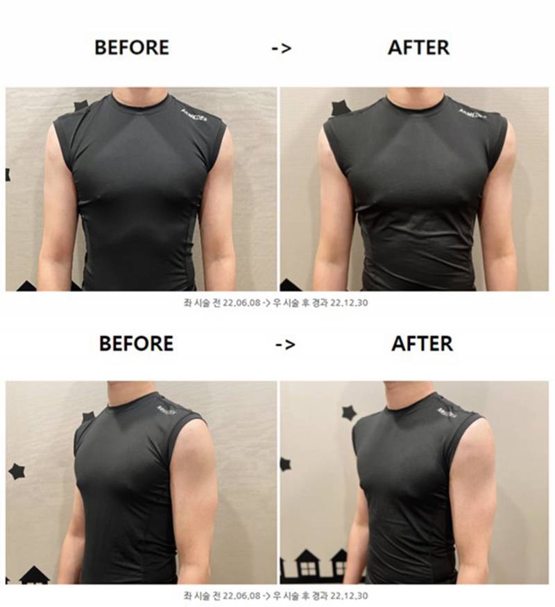 현재 어깨 필러 맞았다는 조두팔..JPG | 인스티즈