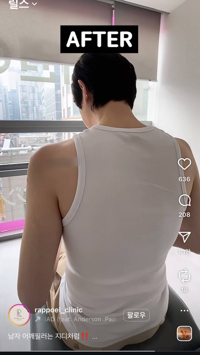 현재 어깨 필러 맞았다는 조두팔..JPG | 인스티즈