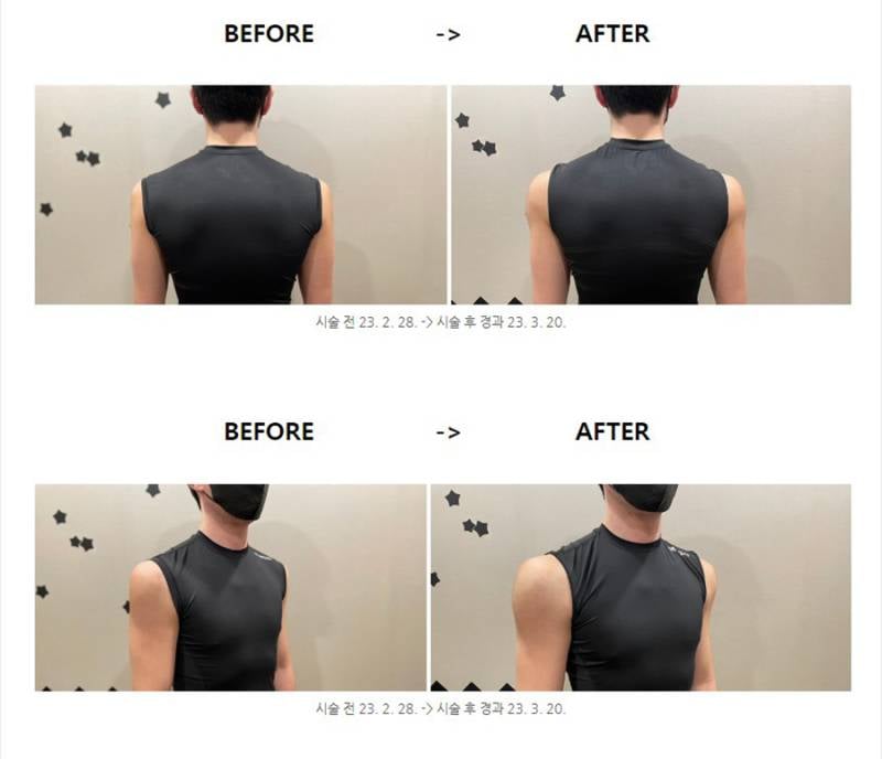 현재 어깨 필러 맞았다는 조두팔..JPG | 인스티즈