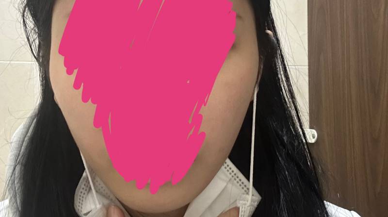 [잡담] 나 옆광대 많이 심해? 수술할정도임? | 인스티즈