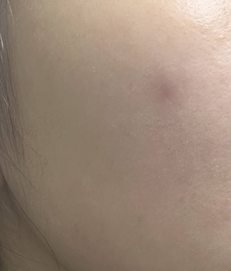 [잡담] 이 여드름 염증주사 맞을까…? | 인스티즈