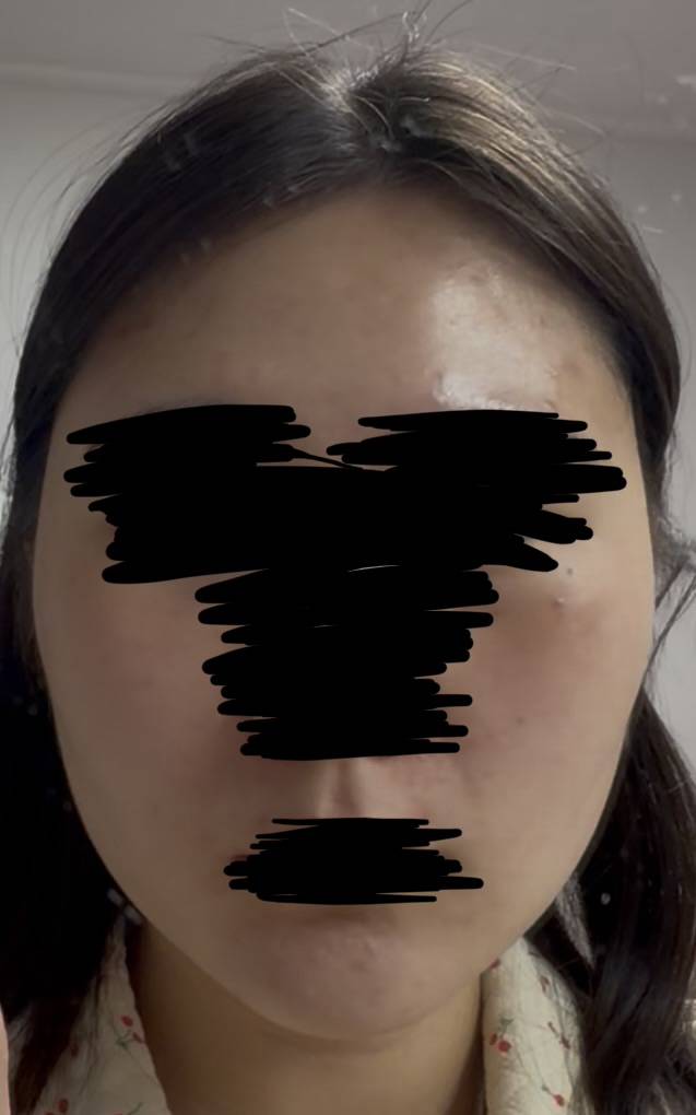 [잡담] 수부지+예민+민감성 피부 좁쌀관리 어떻게 해… | 인스티즈