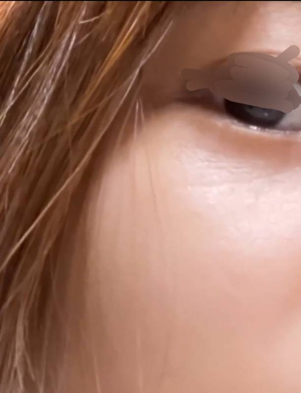 [잡담] 20대 초중반에 눈주름 있는 사람 있어? | 인스티즈