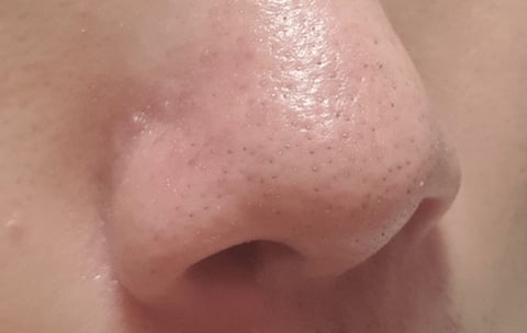 블랙헤드 아니면서 블랙헤드인 척 하는 거 (사진주의) | 인스티즈