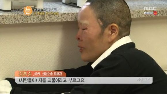 [리얼스토리눈] 15곳을 수술한 여자 내 얼굴을 찾아주세요 (성형수술 부작용) | 인스티즈