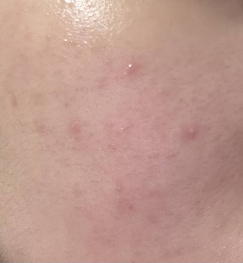 [잡담] 피부 장벽 무너진걸까ㅠㅠ | 인스티즈