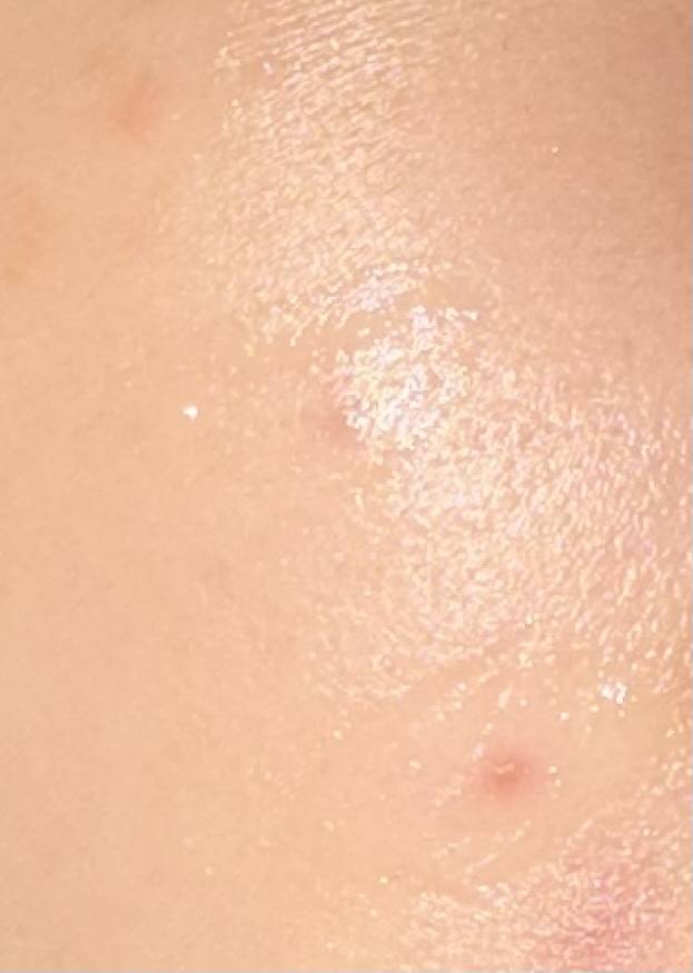 [잡담] 이거 여드름이야??? | 인스티즈