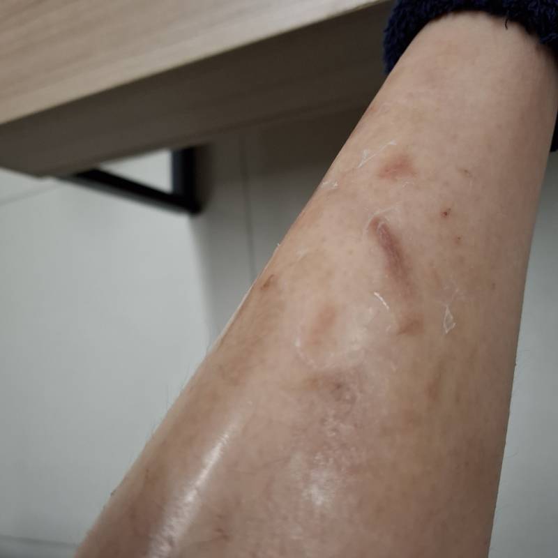 [잡담] 상처에 껍질은 왜 벗겨지는거야? | 인스티즈