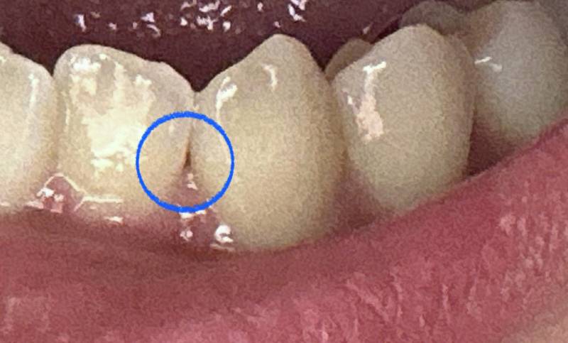 [잡담] 이 사이에 이거 충치일까???.. ㅎㅇㅈㅇ | 인스티즈