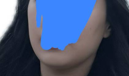 [잡담] 나 이거 볼패임이야?ㅠㅠ 이거 시술 뭐 추천해줄수있을까?ㅠㅠ | 인스티즈