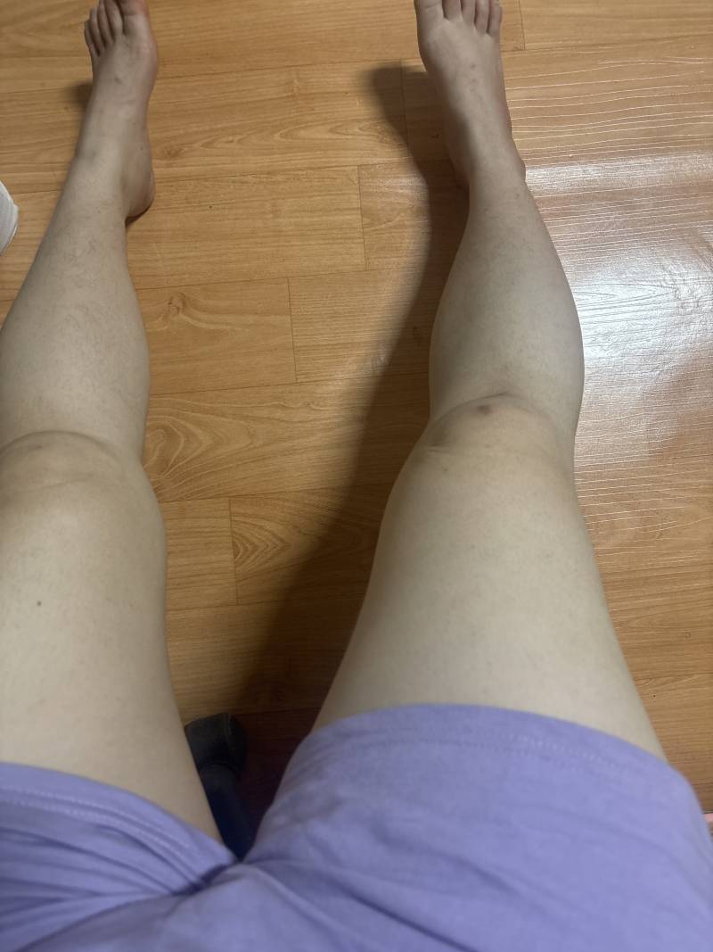 [잡담] 다리 ㄹㅇ굵다 원래 상비엿는데 상하둘다비만댐 | 인스티즈