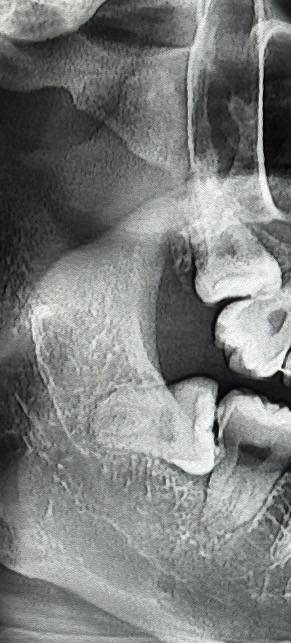 [잡담] 사랑니 잘알있어? 난이도 높은거야? | 인스티즈