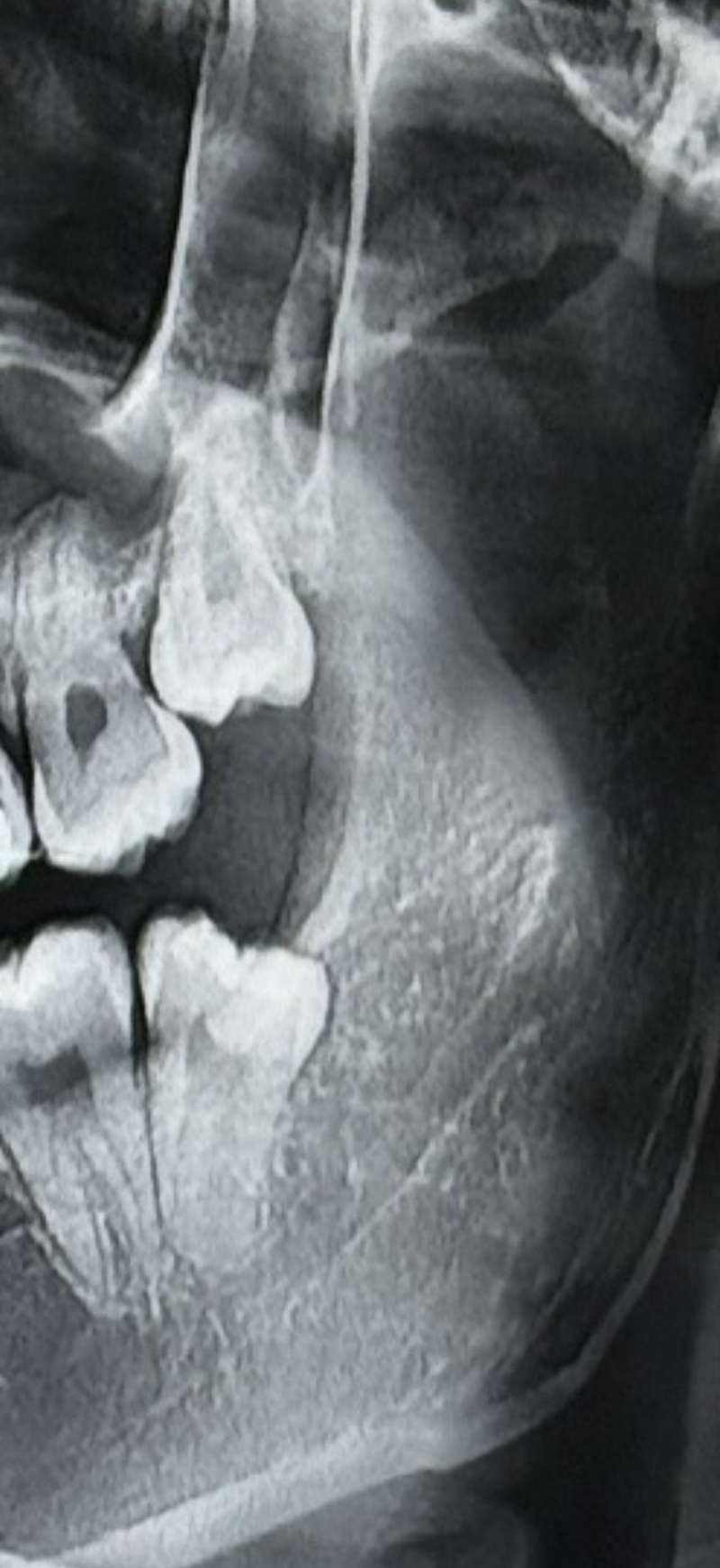 [잡담] 사랑니 잘알있어? 난이도 높은거야? | 인스티즈