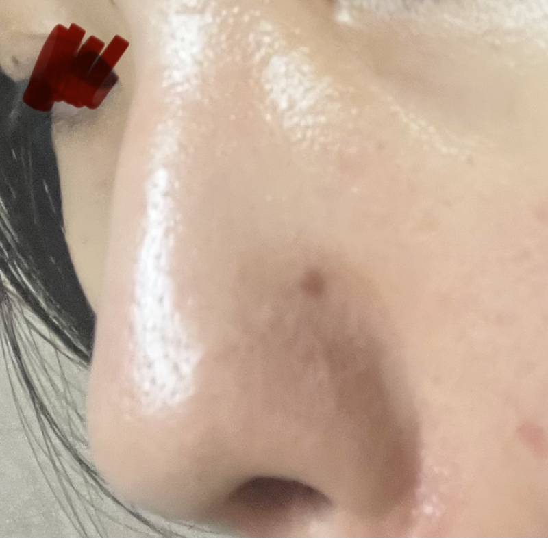 [잡담] 나 갑자기 코에 이상한 점 생겼는데 | 인스티즈