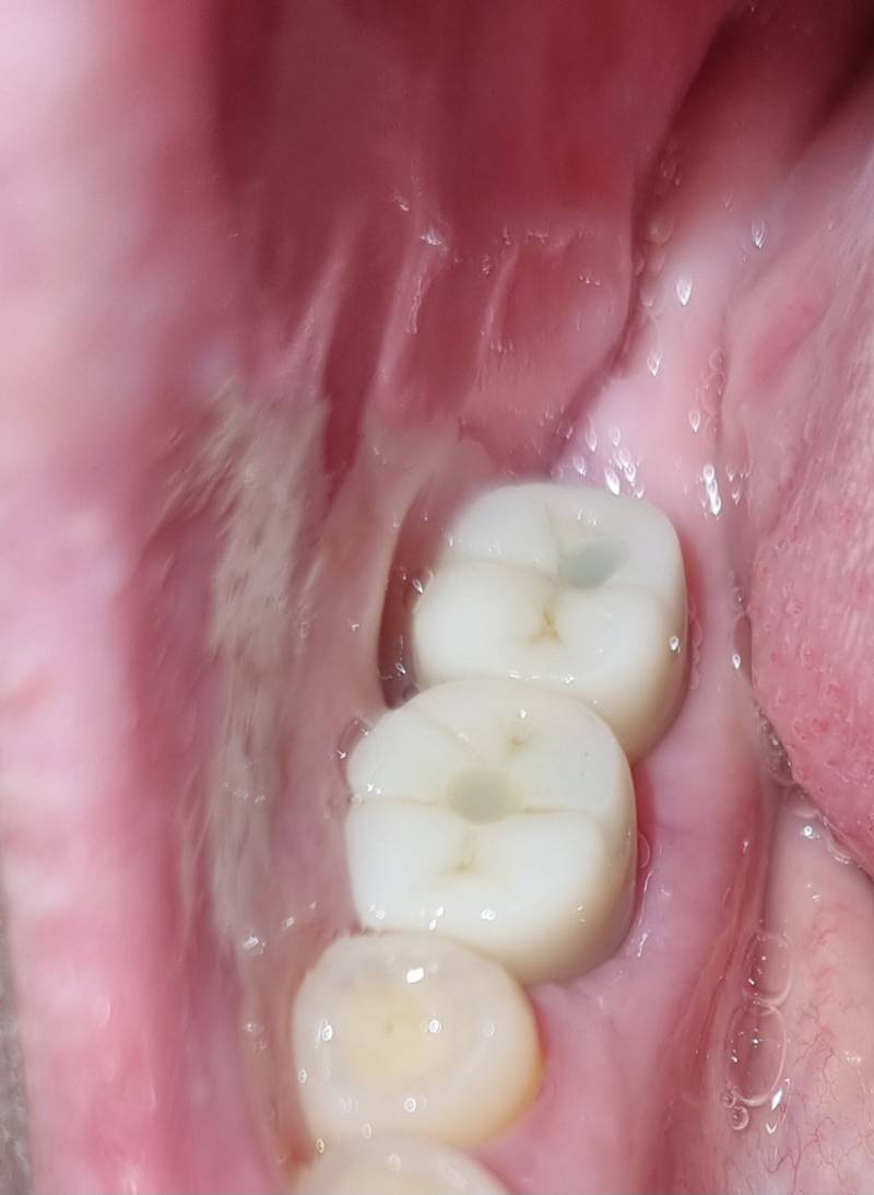 [잡담] 임플란트가 원래 이렇게 티나..? ㅎㅇㅈㅇ | 인스티즈