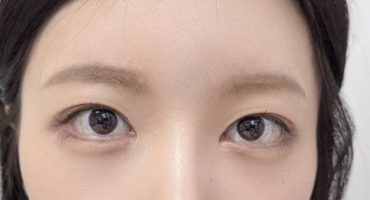 [잡담] 쌍커풀 재수술 할말... | 인스티즈